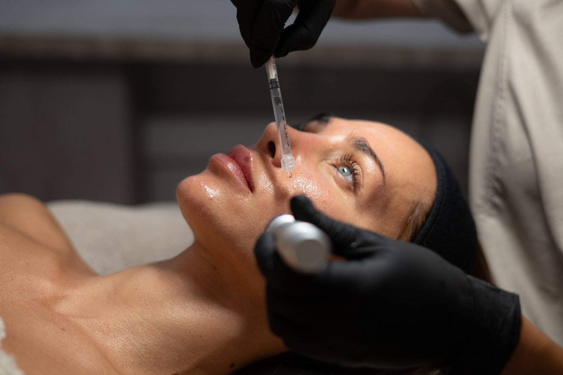 exosomes-microneedling-face