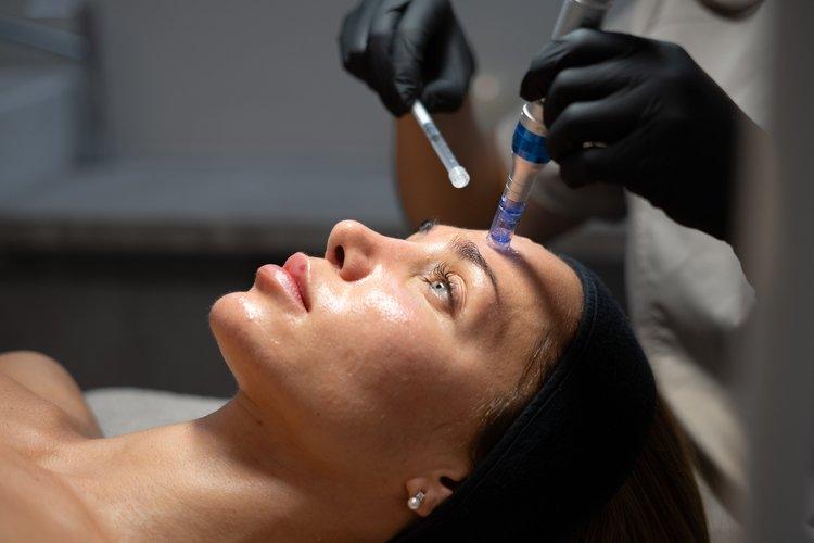 exosomes-microneedling-face-section-2