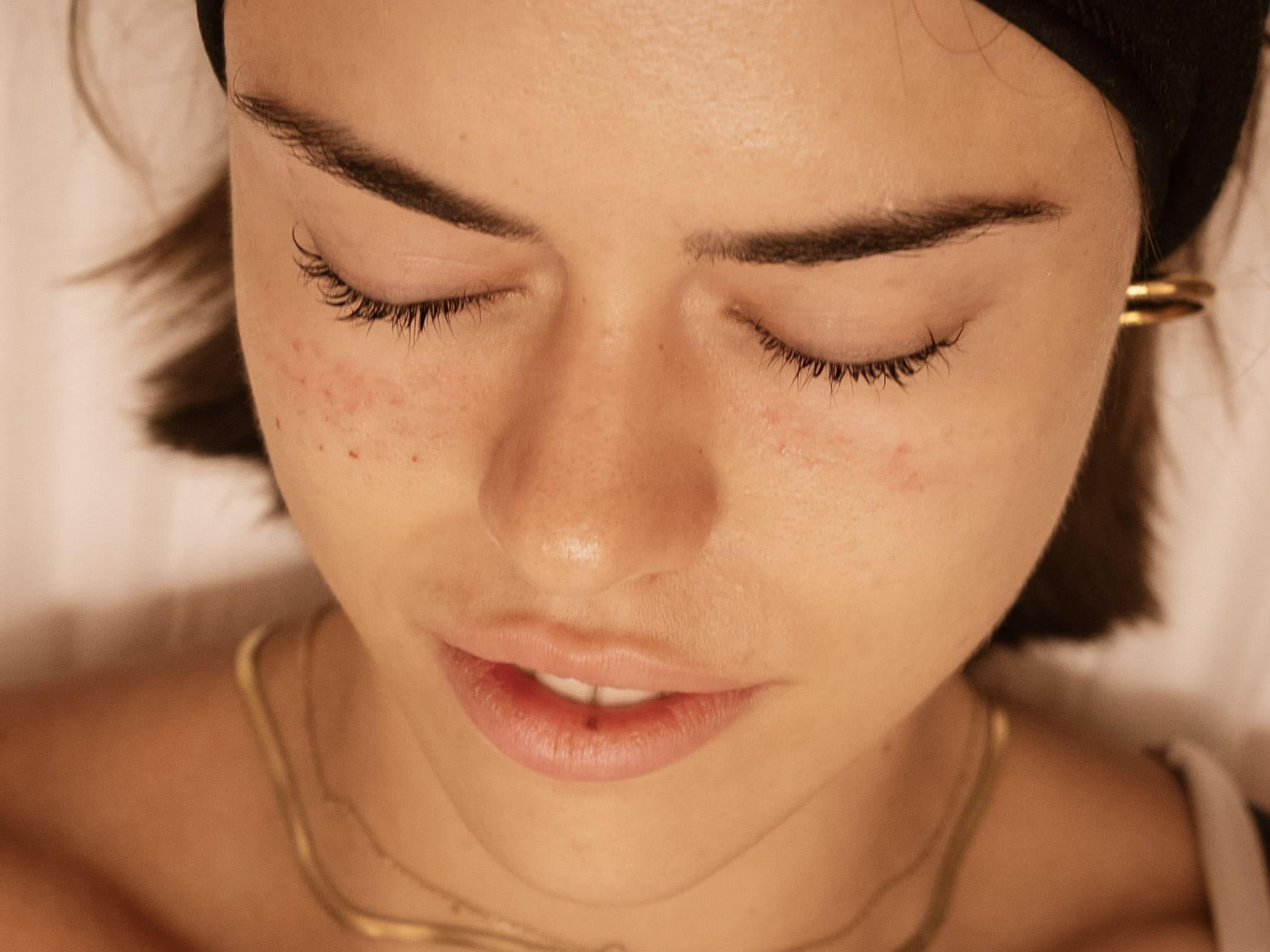 facial-mesotherapy