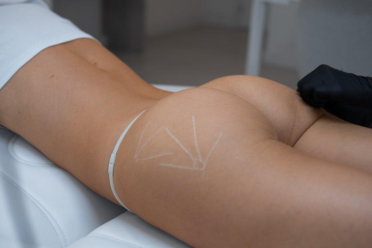 gluteal-hyaluronic-augmentation-section-2