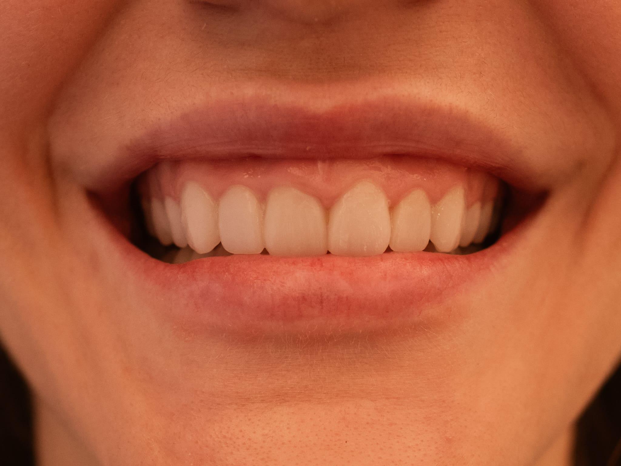 gummy-smile