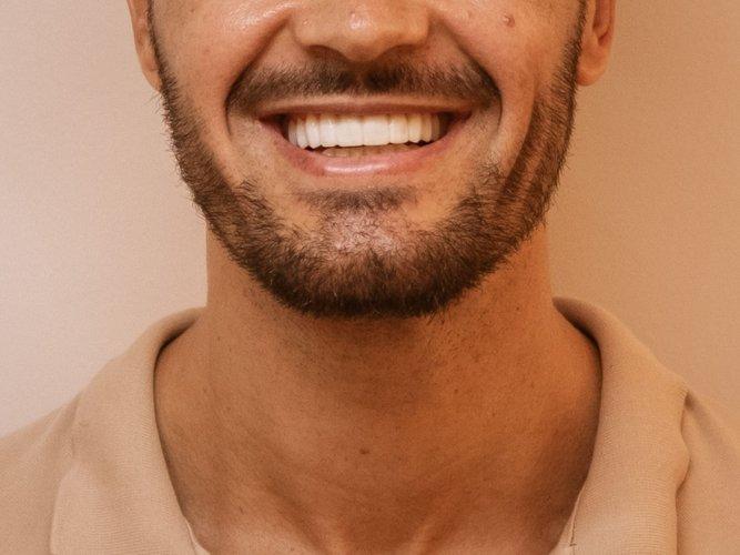 gummy-smile-section-2