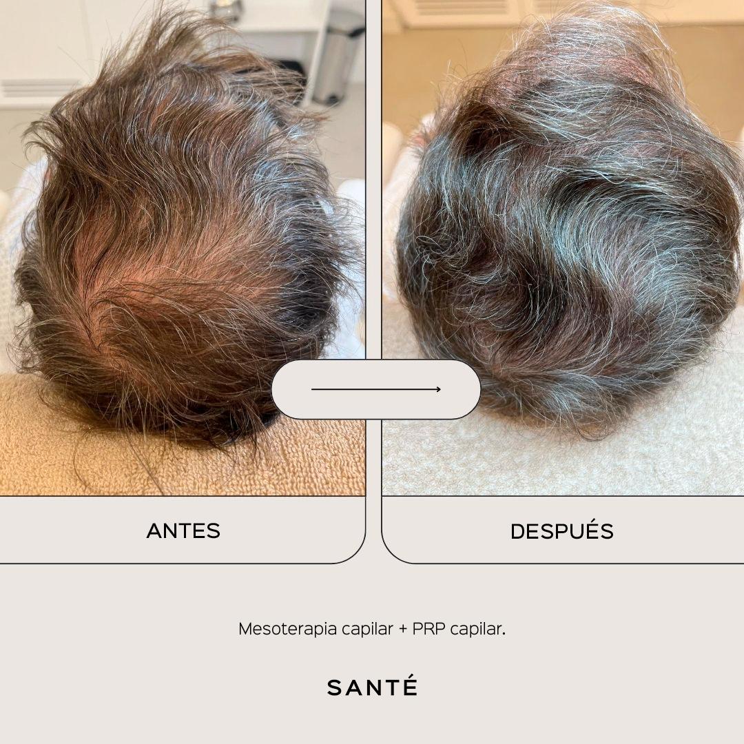 hair-mesotherapy-media-1
