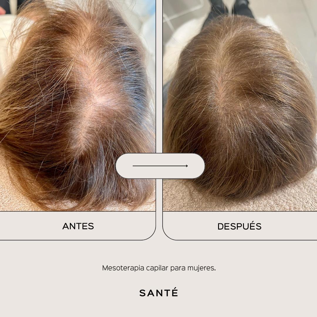 hair-mesotherapy-media-2