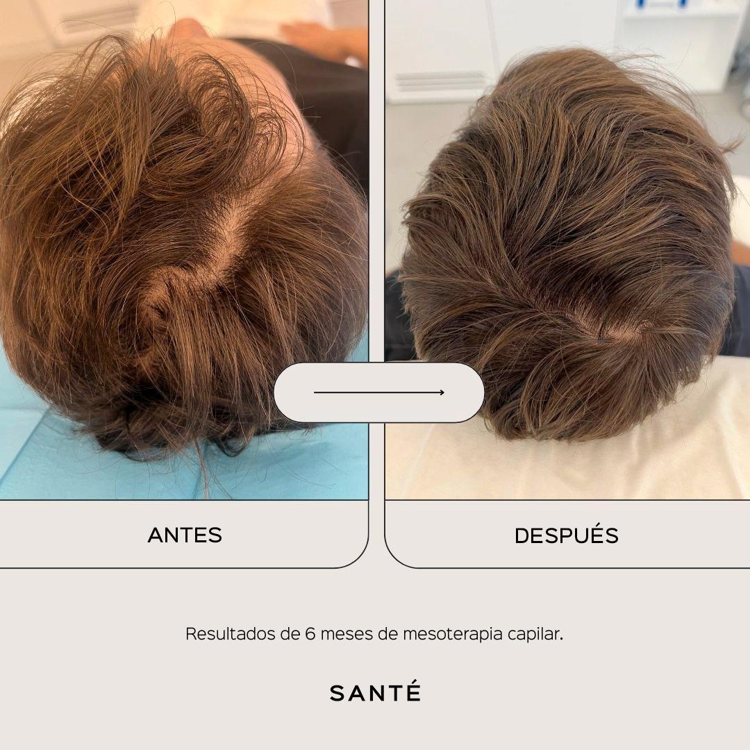 hair-mesotherapy-media-3