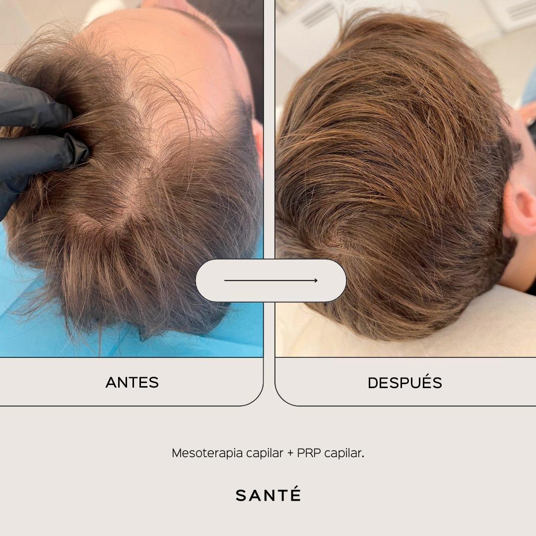 hair-mesotherapy-media-4