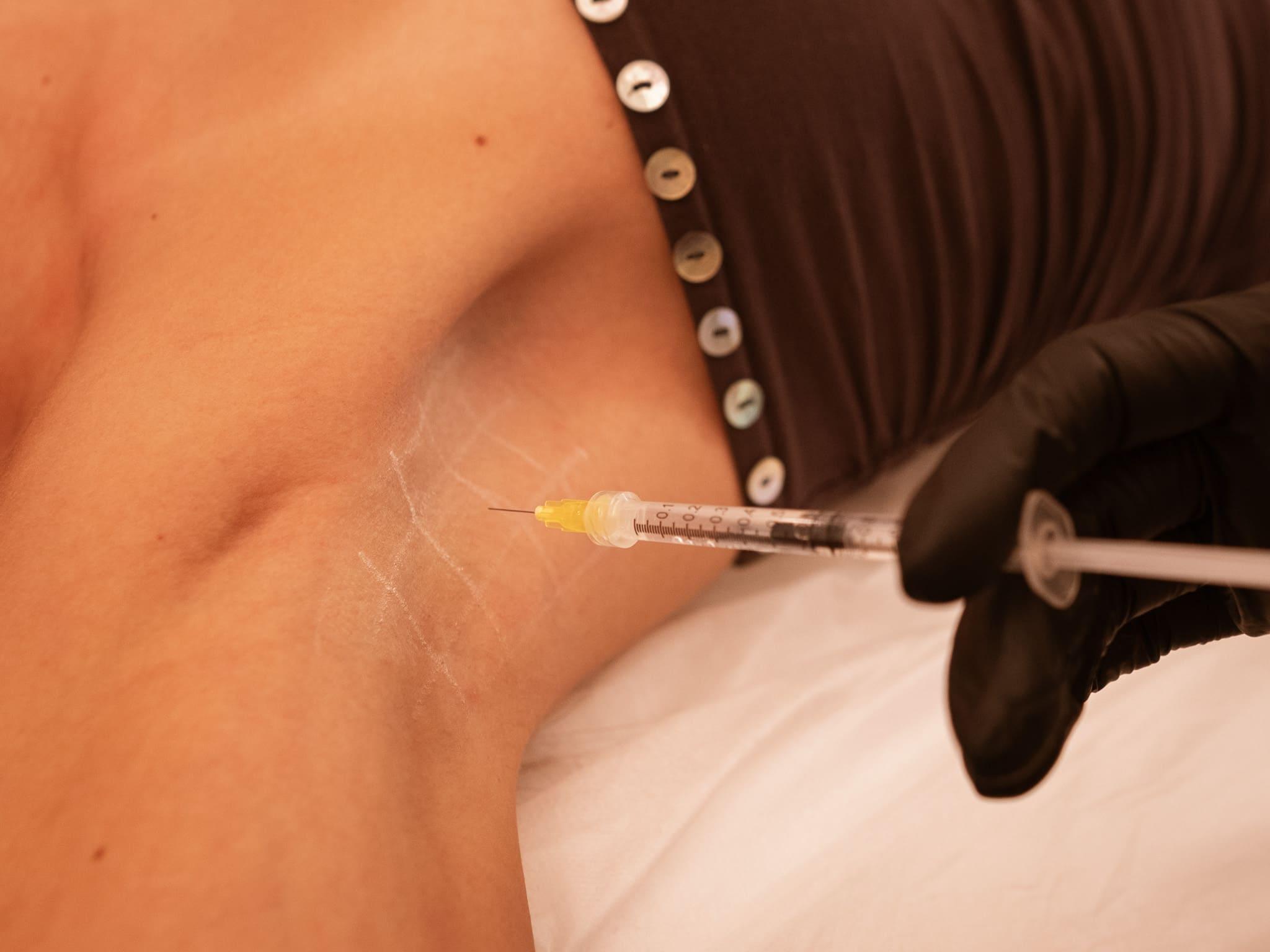 hiperhidrosis