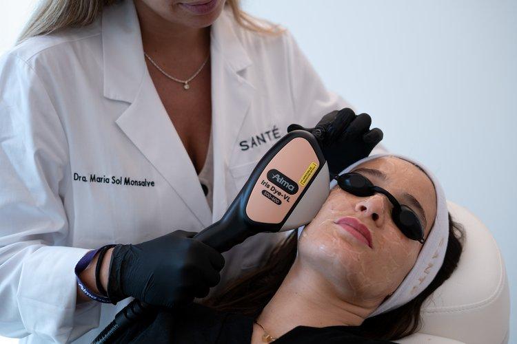 laser-rosacea-home