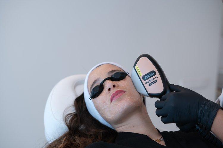 laser-rosacea-section-3