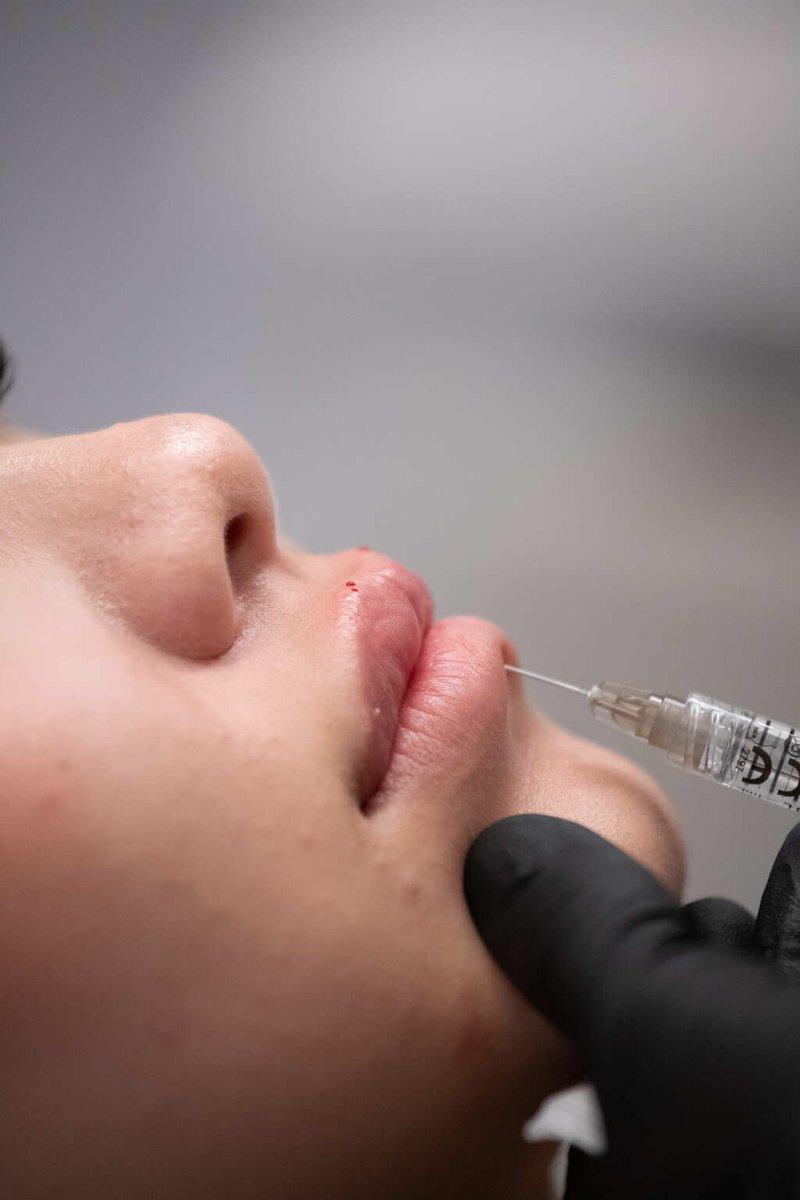 lip-filling-and-hydration-home