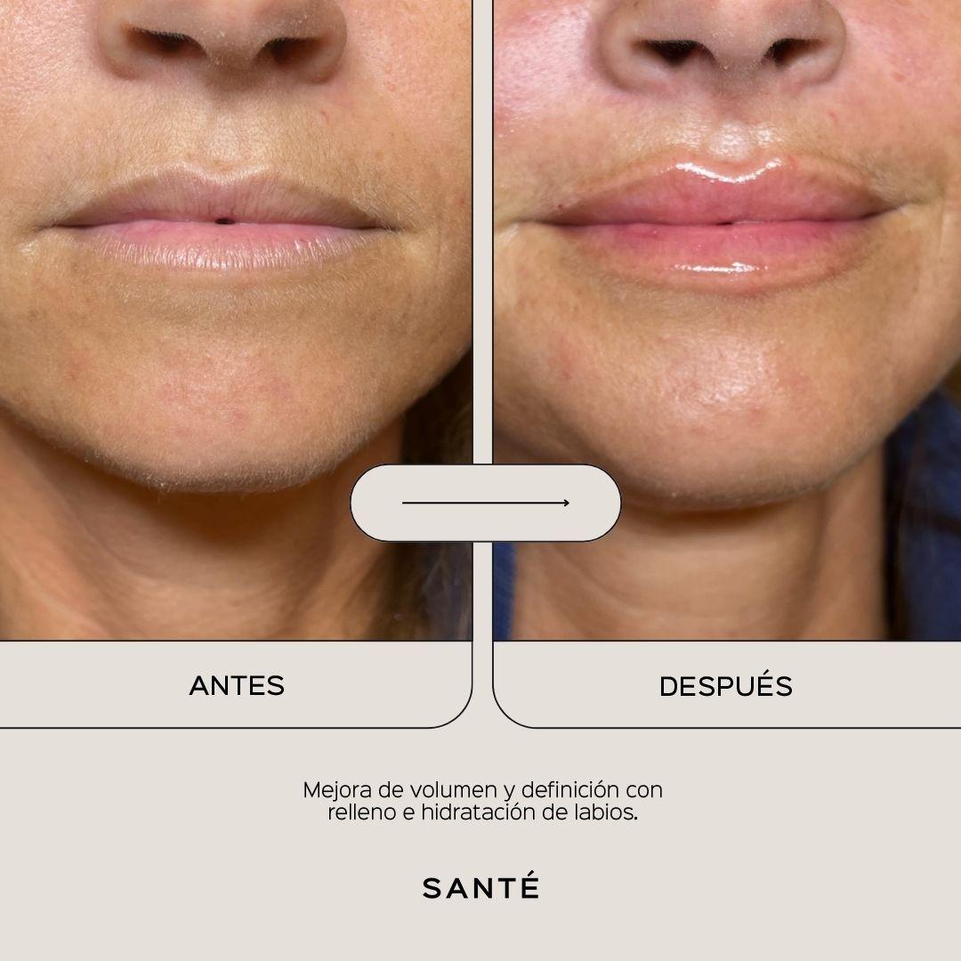 lip-filling-and-hydration-media-3