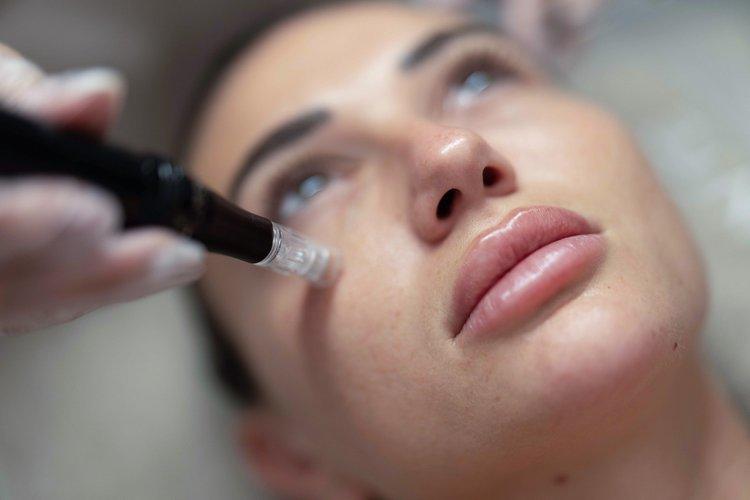 microneedling-section-2