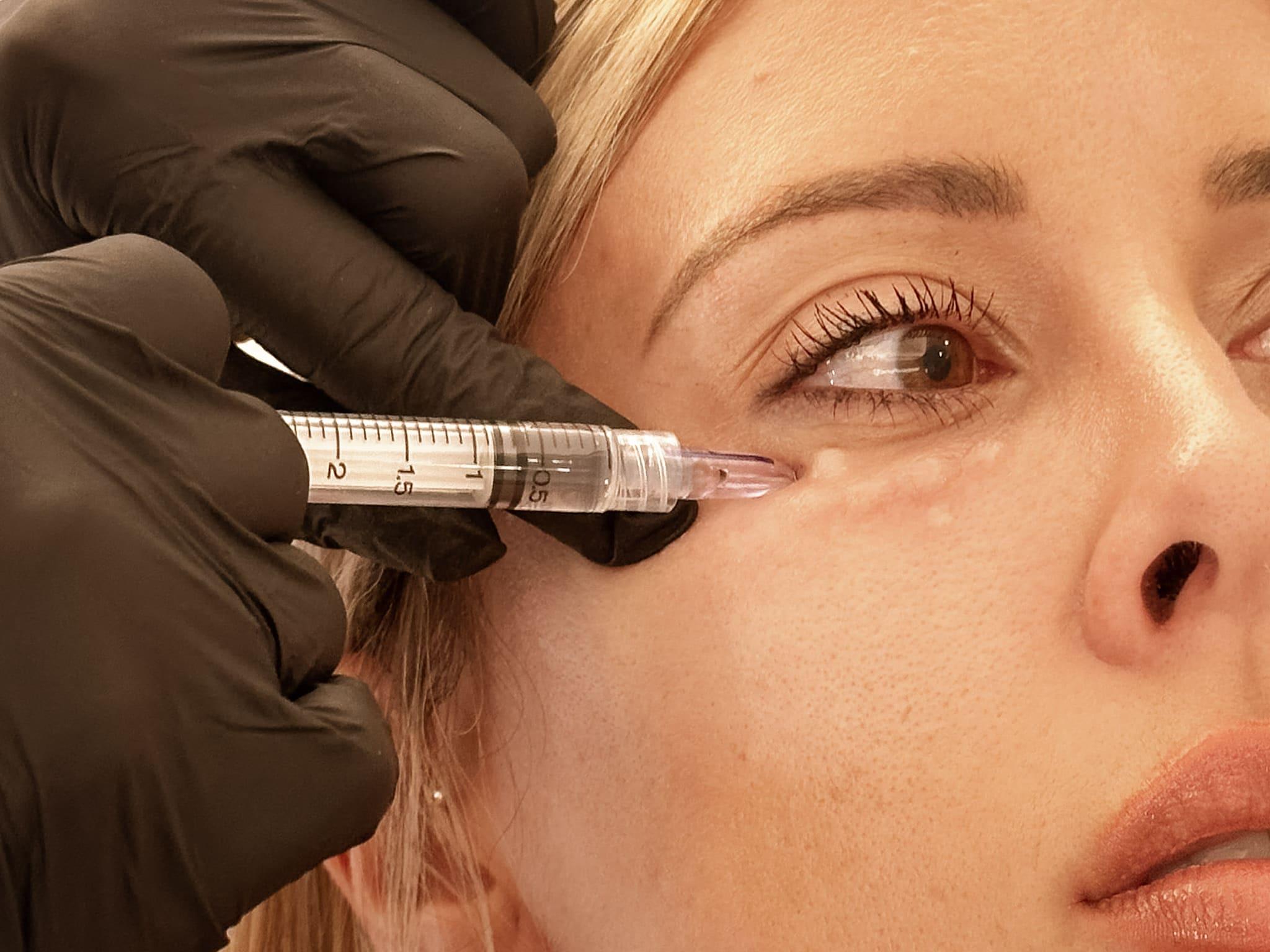 periocular-mesotherapy