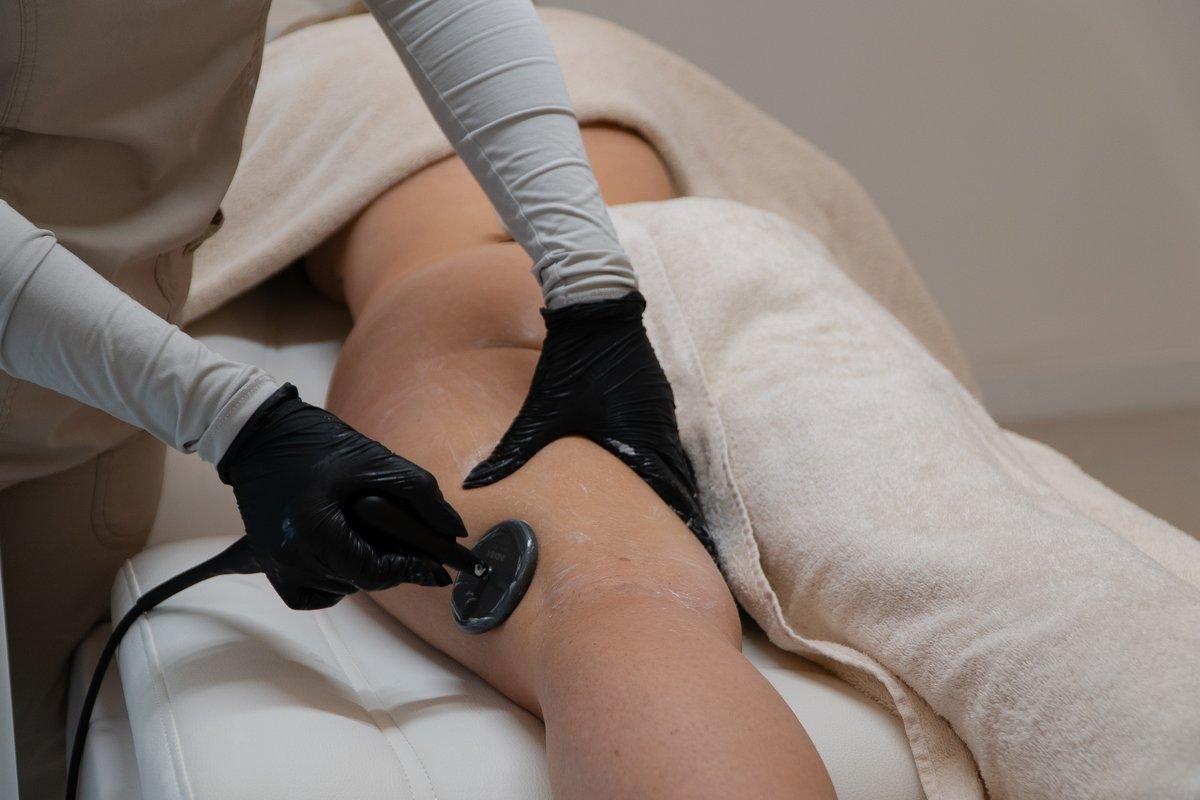 cellulite-subcision-section-3