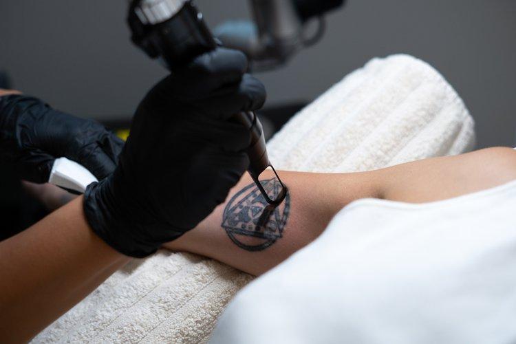 tattoo-removal-section-3