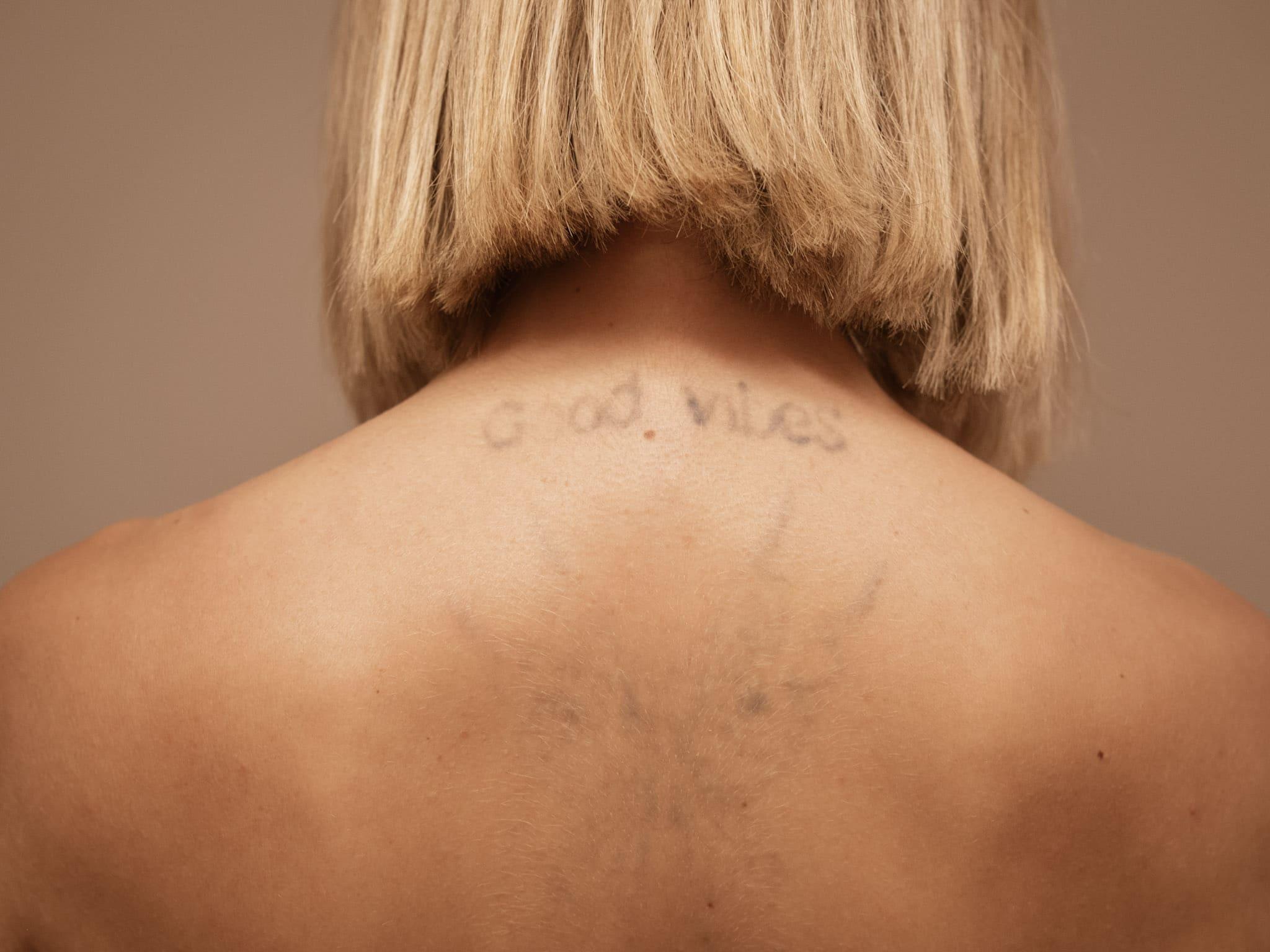 tattoo-removal