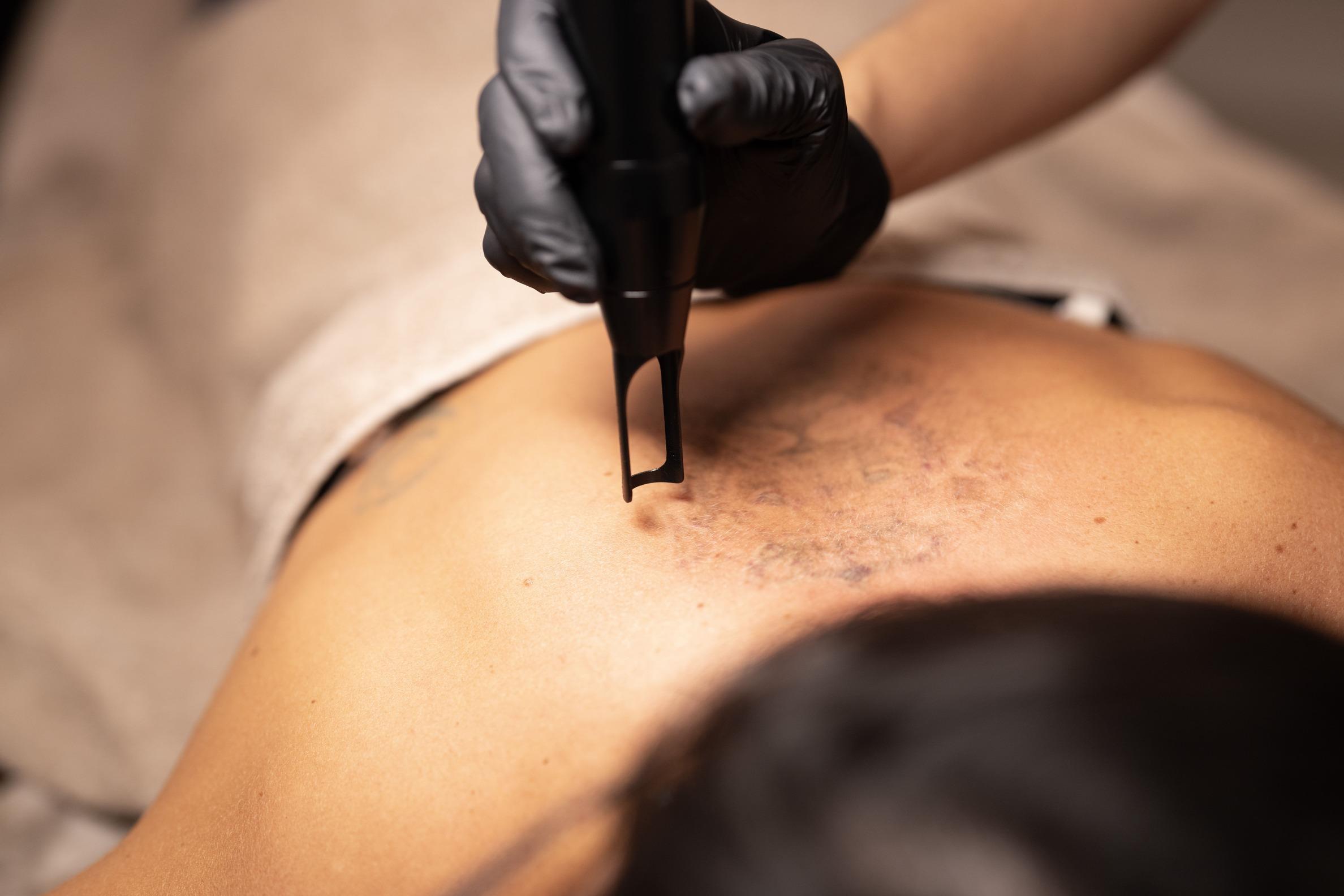 tattoo-removal-section-3