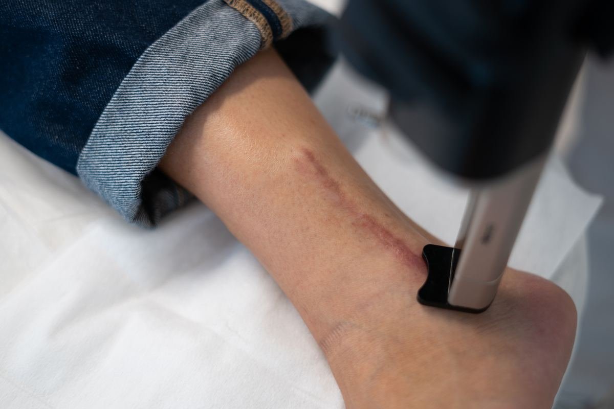 co2-scars-section-2