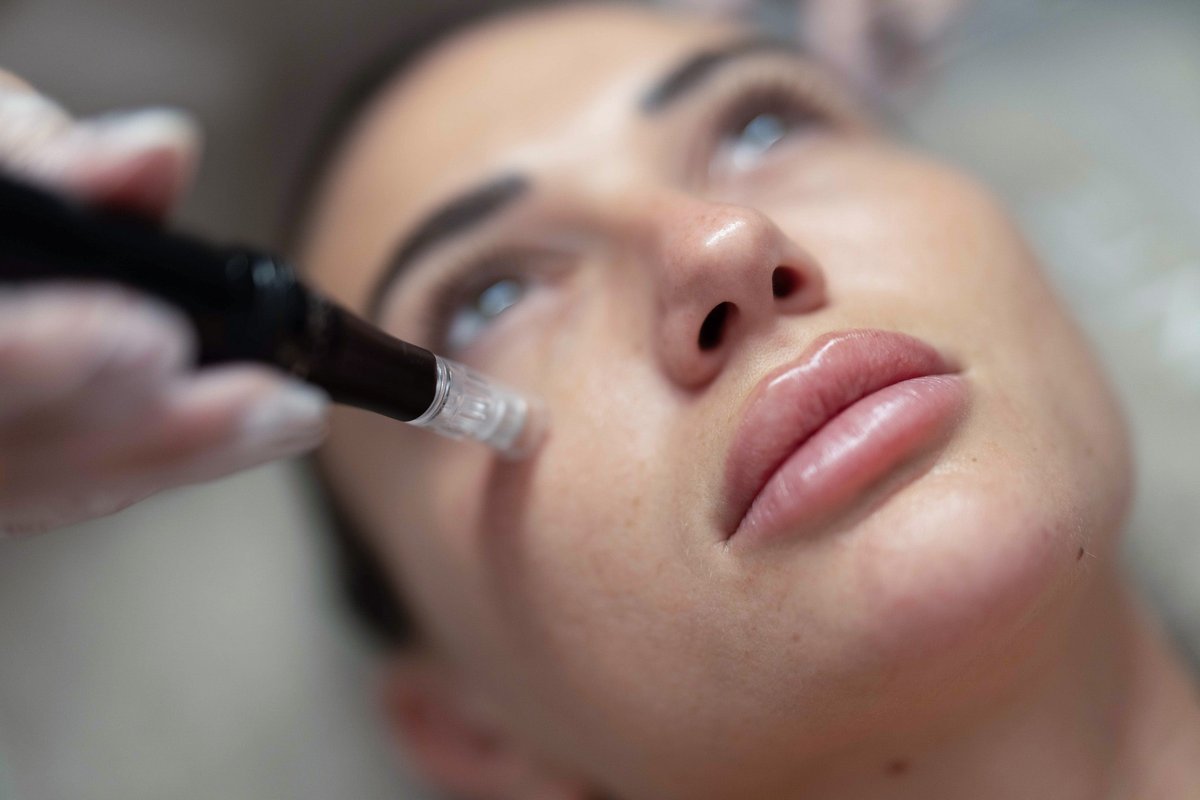 limpiezas-microneedling-section-1