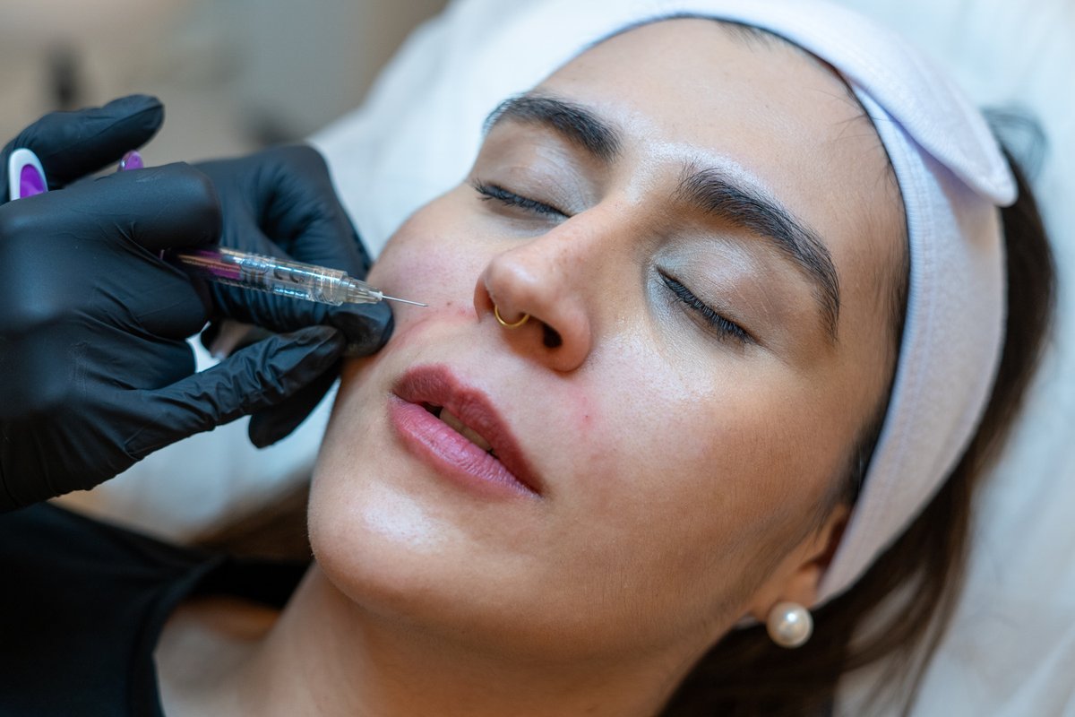 nasolabial-fold-section-1