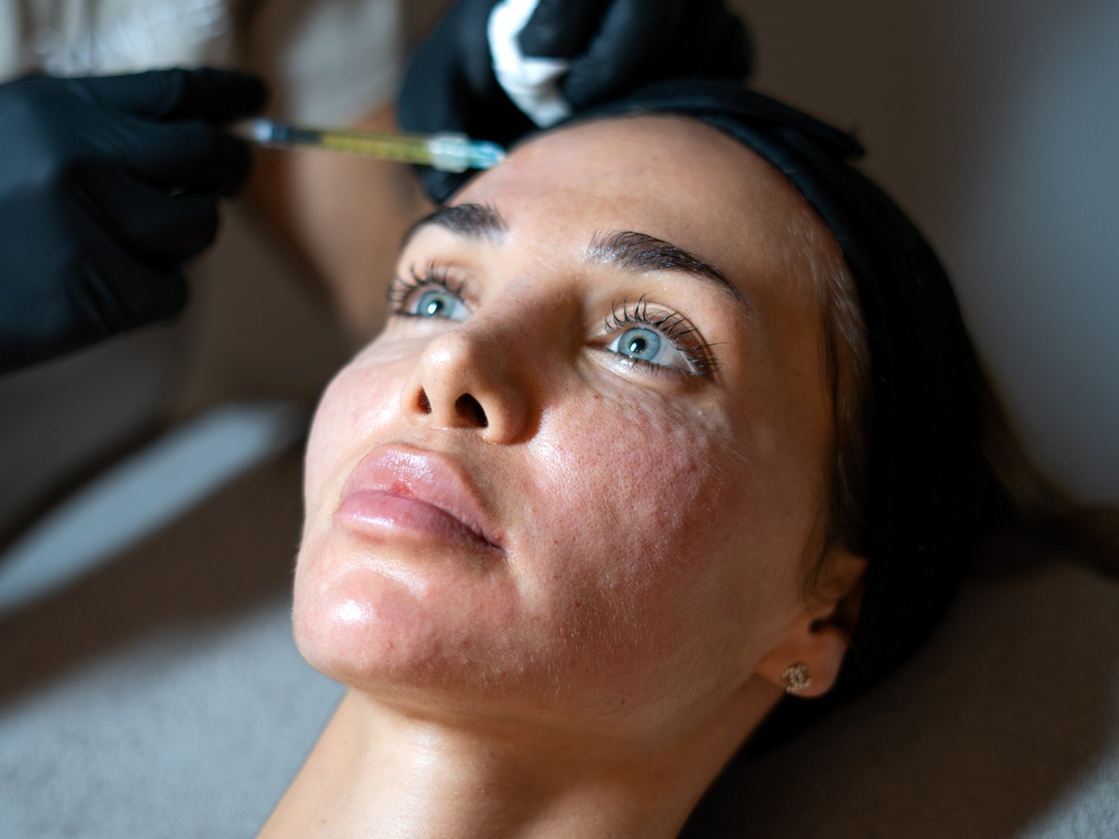 prf-injectable-facial-section-2