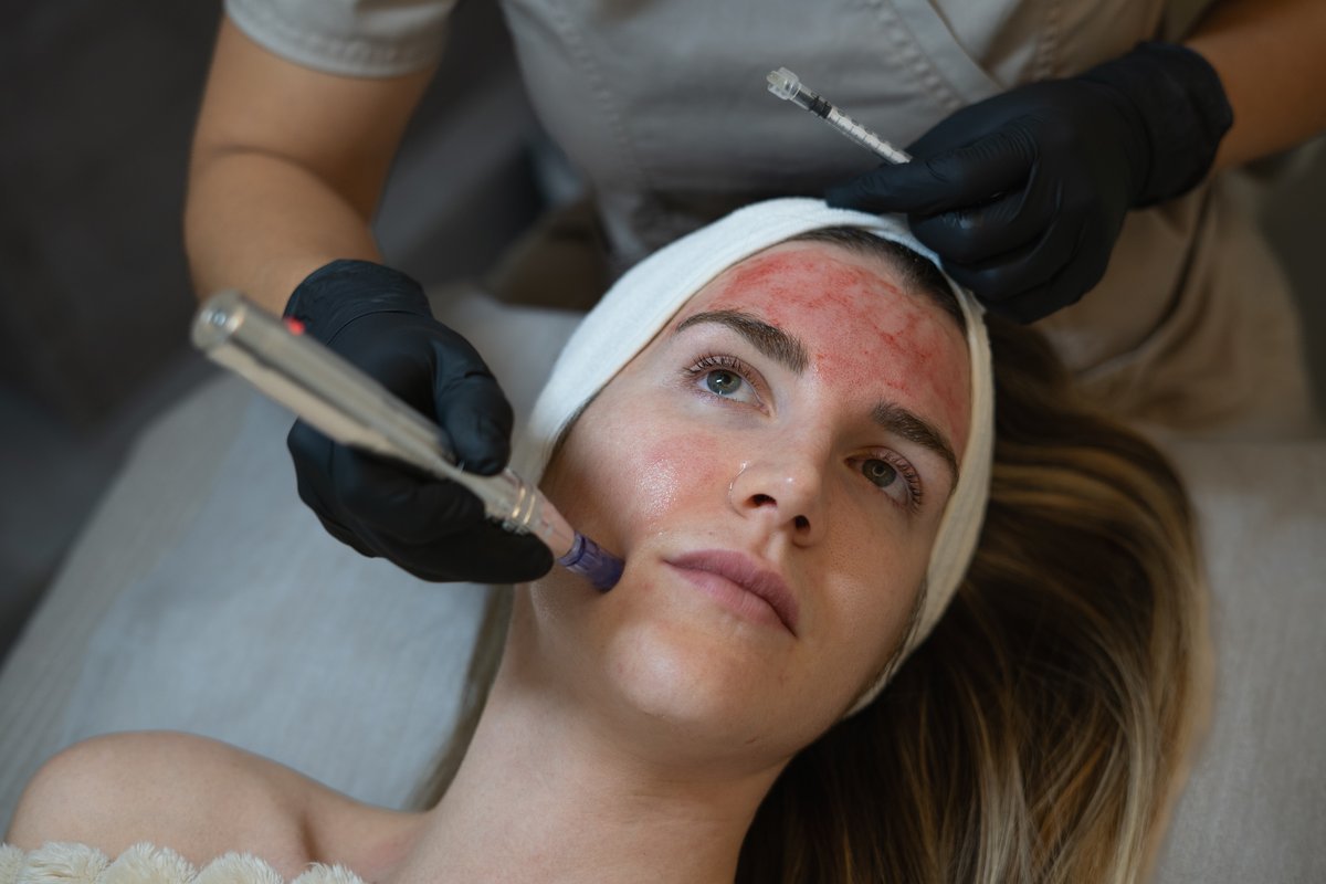 vampire-facial-section-1