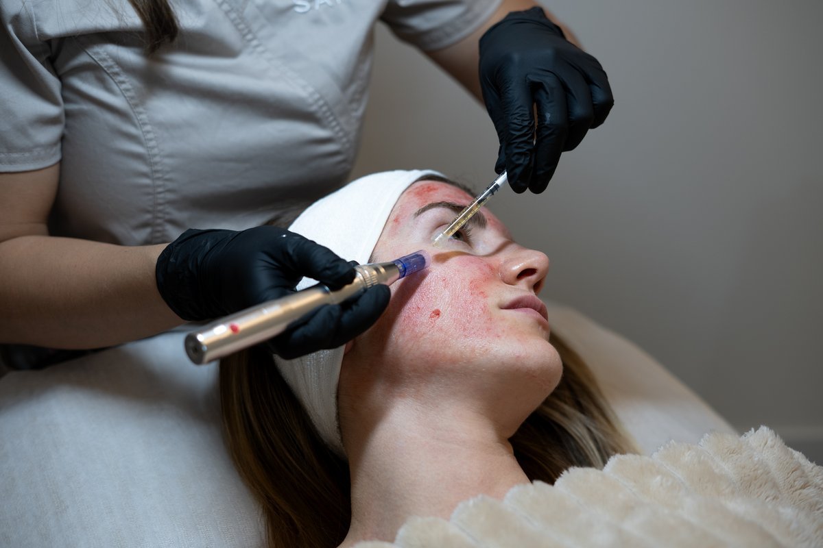 vampire-facial-section-2