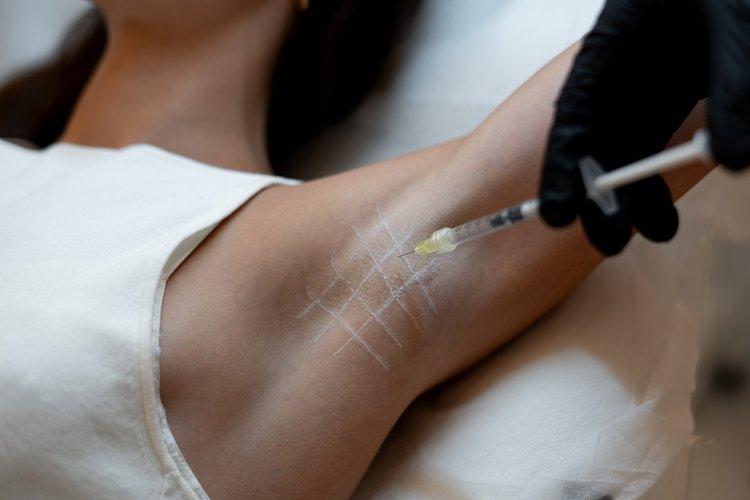 hiperhidrosis-section-1